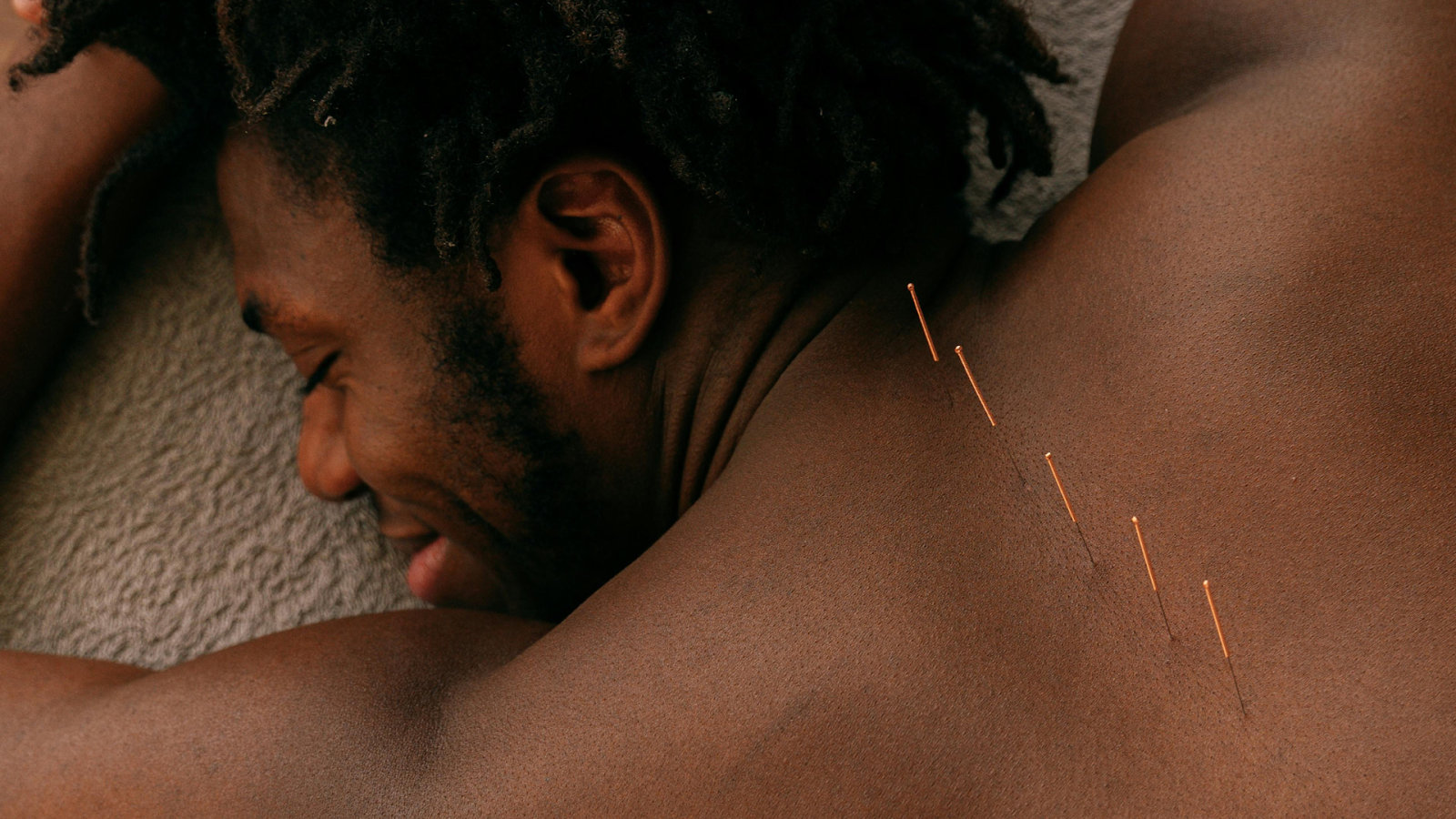 Acupuncture For Stress