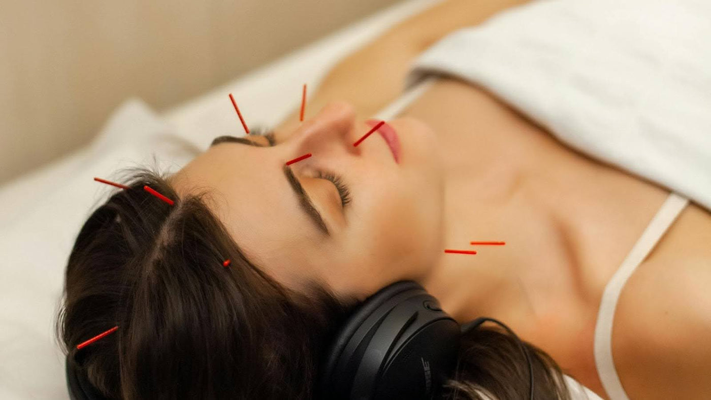 Acupuncture For Acne