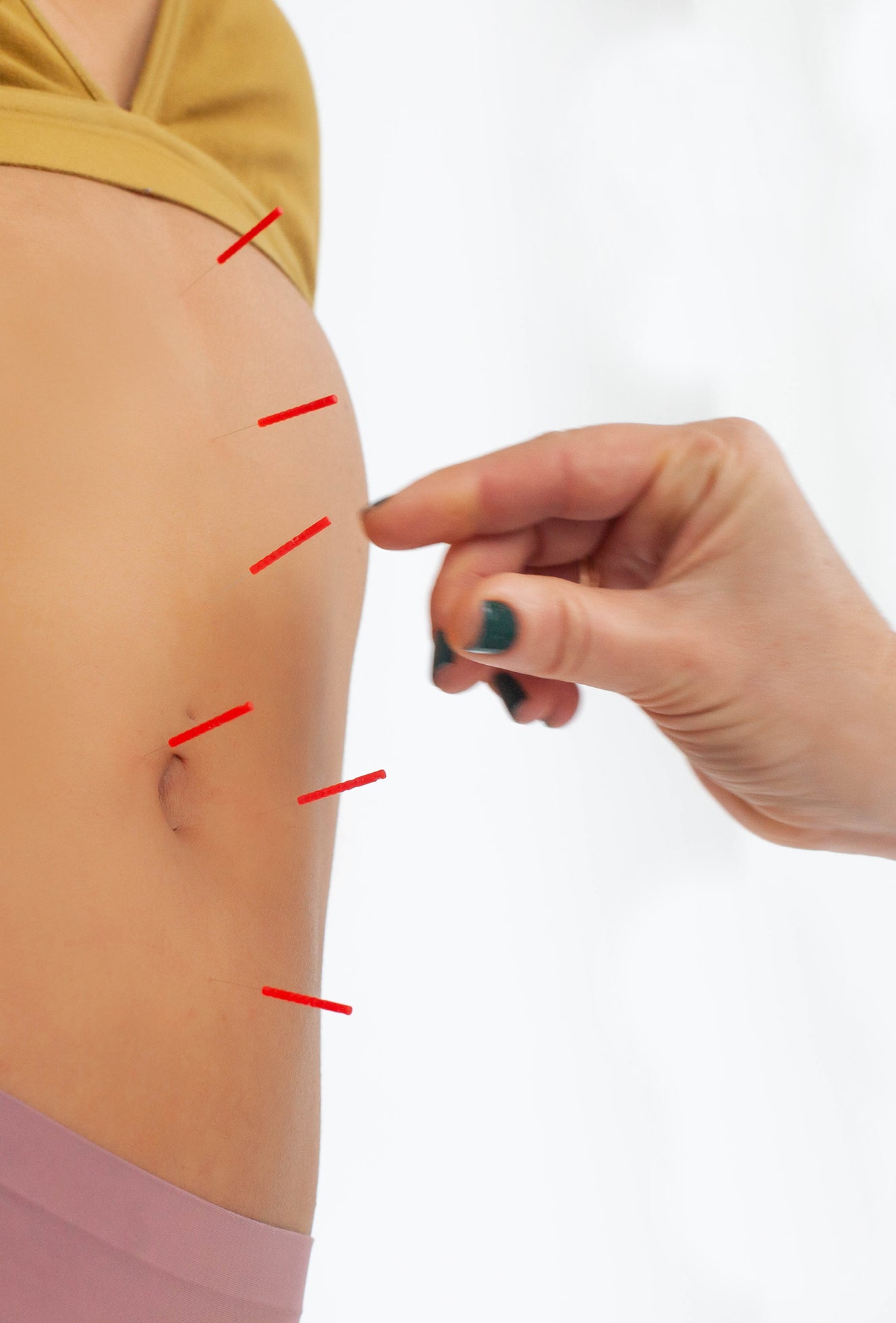 Dry Needling vs Acupuncture: What's the Difference?