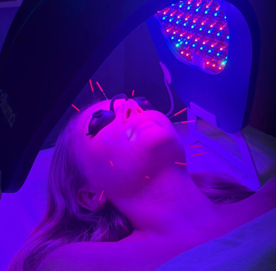 Facial Acupuncture: The No Tox, All Lift Way To Naturally Glow