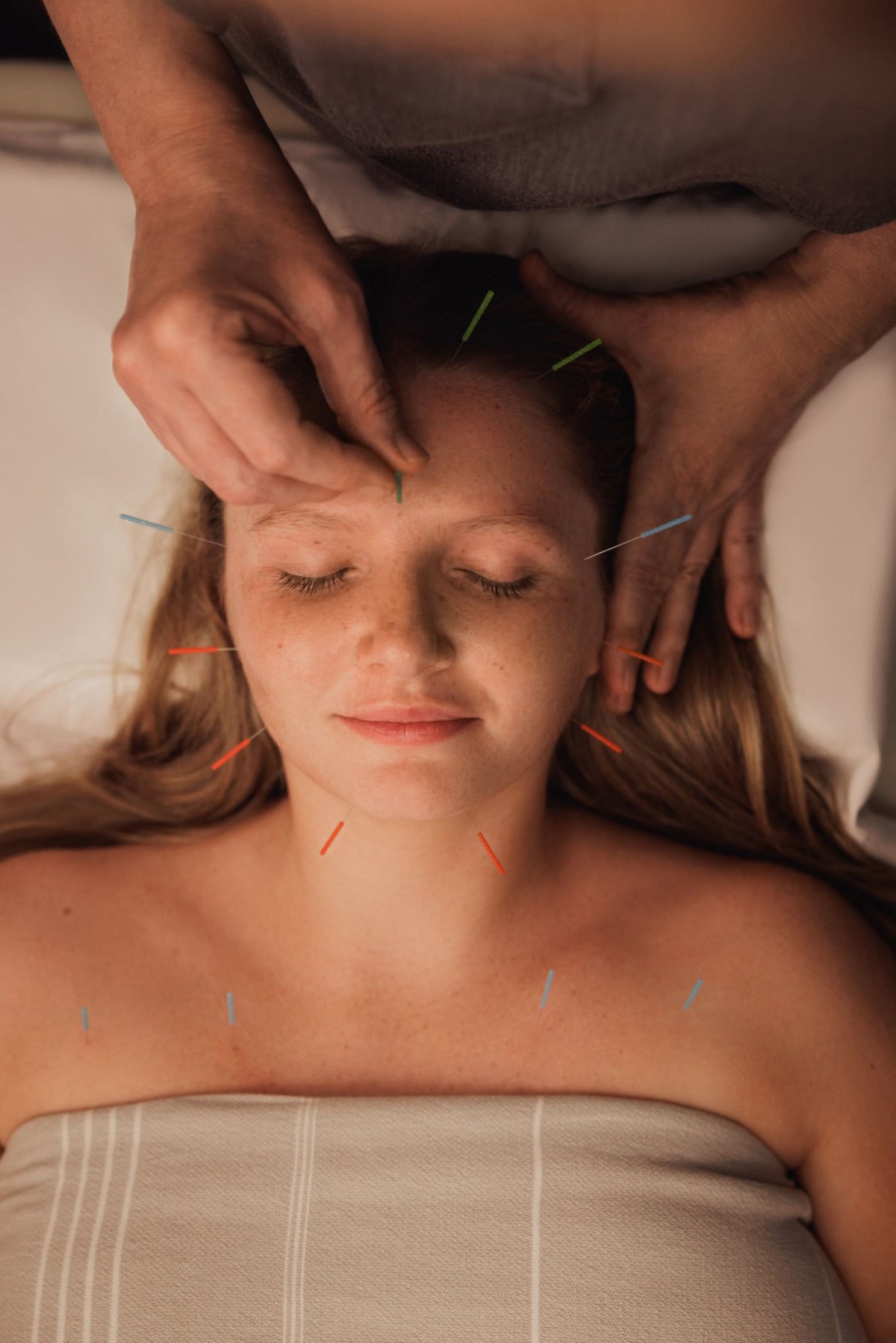 Facial acupuncture treatment with needles at forehead, cheeks, and chest