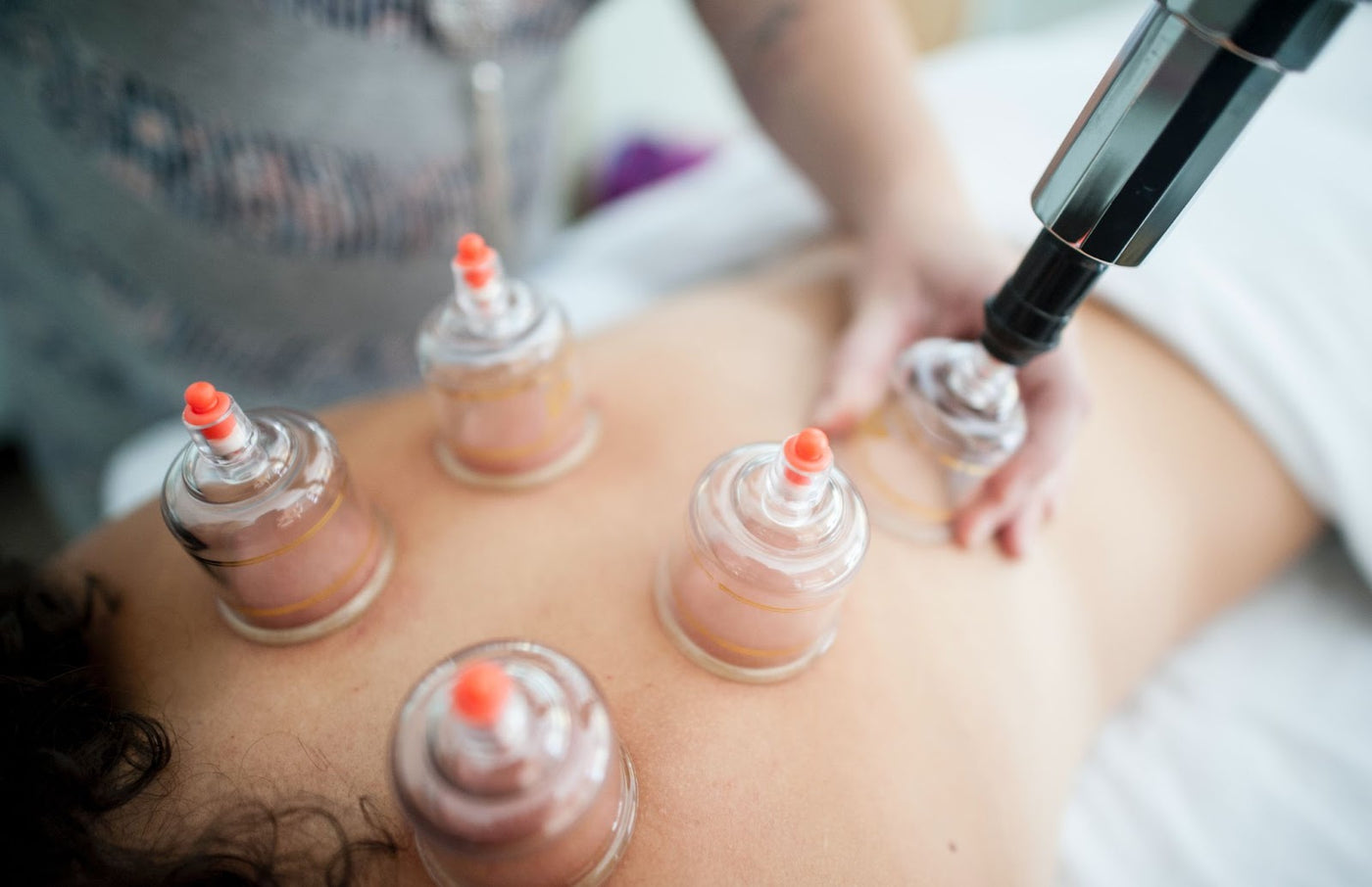 What To Expect After Cupping Therapy: Recovery Processes and More