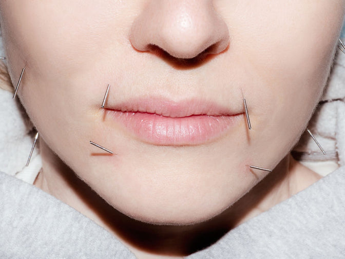 I Tried Acupuncture for the First Time—and It Was Nothing Like I Expected
