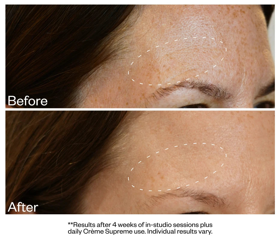 Fine lines at the brow