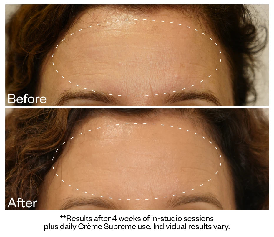 Forehead lines