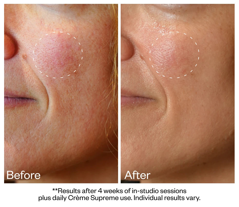 Redness across the cheek