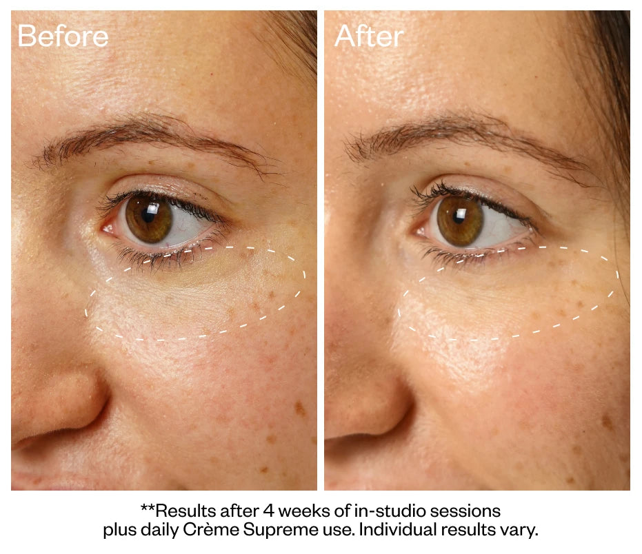 Under-eye texture and tone